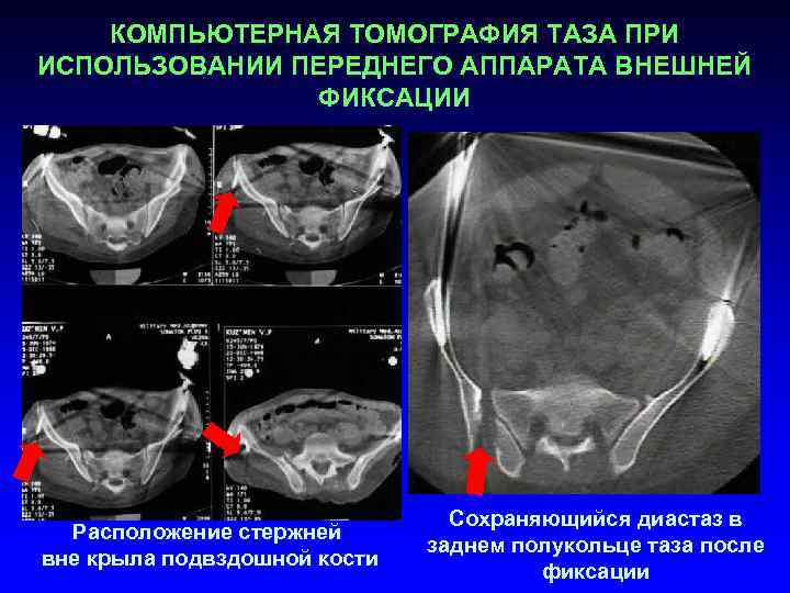 КОМПЬЮТЕРНАЯ ТОМОГРАФИЯ ТАЗА ПРИ ИСПОЛЬЗОВАНИИ ПЕРЕДНЕГО АППАРАТА ВНЕШНЕЙ ФИКСАЦИИ Расположение стержней вне крыла подвздошной