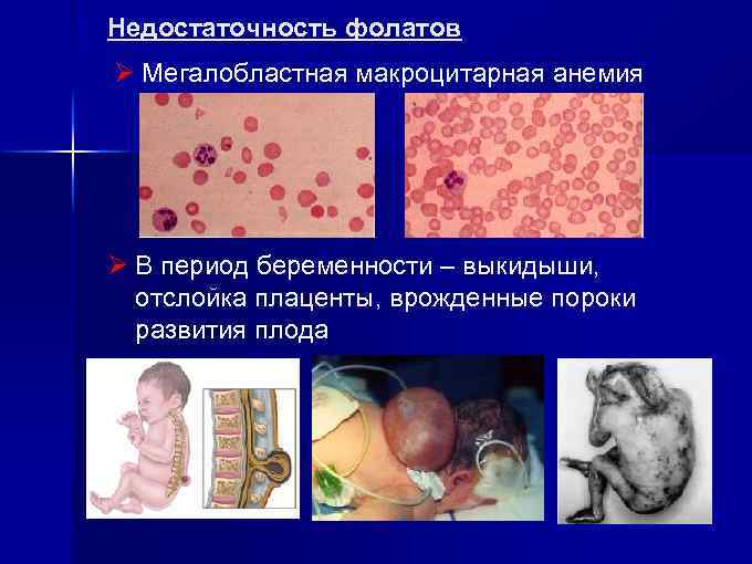 Недостаточность фолатов Ø Мегалобластная макроцитарная анемия Ø В период беременности – выкидыши, отслойка плаценты,