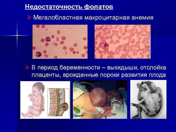 Недостаточность фолатов Ø Мегалобластная макроцитарная анемия Ø В период беременности – выкидыши, отслойка плаценты,