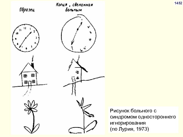 1 схему рисунок отражающие нарушения зрительного внимания игнорировании какой либо стороны