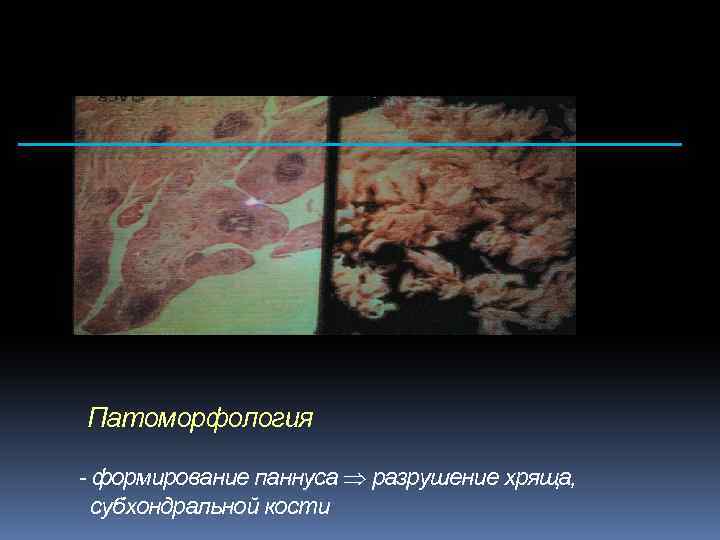 Патоморфология - формирование паннуса разрушение хряща, субхондральной кости 