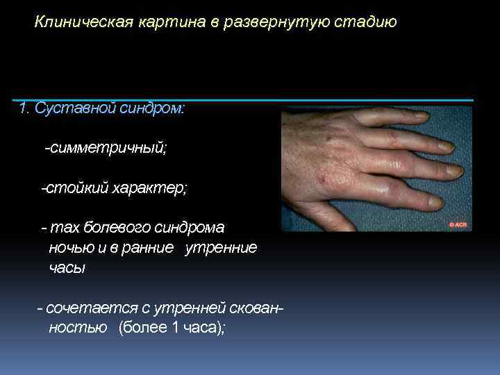 Клиническая картина в развернутую стадию 1. Суставной синдром: -симметричный; -стойкий характер; - max болевого