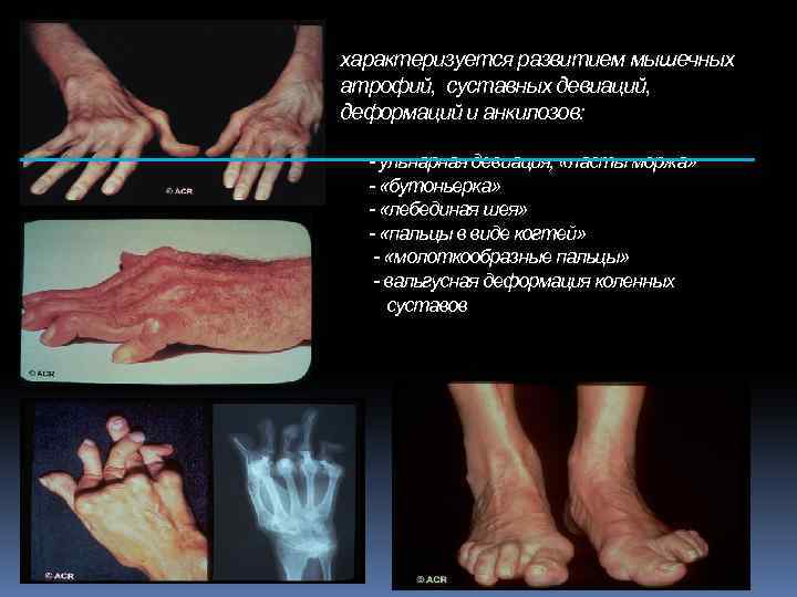 характеризуется развитием мышечных атрофий, суставных девиаций, деформаций и анкилозов: - ульнарная девиация, «ласты моржа»