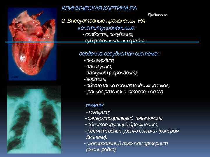 КЛИНИЧЕСКАЯ КАРТИНА РА Продолжение 2. Внесуставные проявления РА конституциональные: - слабость, похудание, - субфебрильная