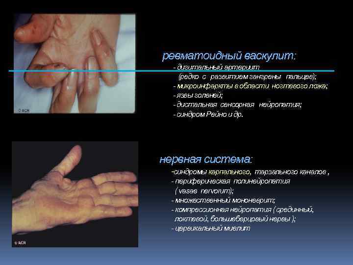 ревматоидный васкулит: - дигитальный артериит (редко с развитием гангрены пальцев); - микроинфаркты в области