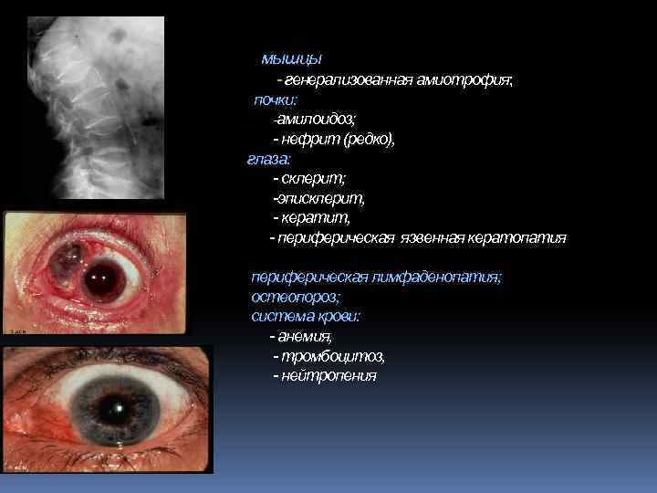 мышцы - генерализованная амиотрофия; почки: -амилоидоз; - нефрит (редко), глаза: - склерит; -эписклерит, -