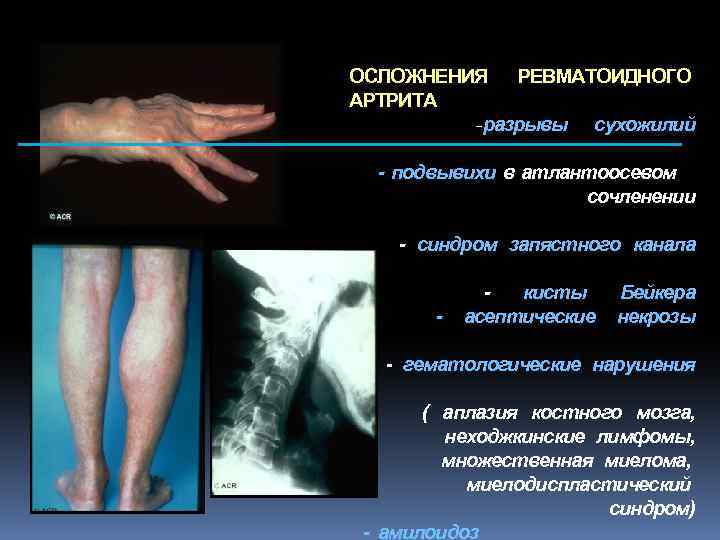 ОСЛОЖНЕНИЯ РЕВМАТОИДНОГО АРТРИТА -разрывы сухожилий - подвывихи в атлантоосевом сочленении - синдром запястного канала