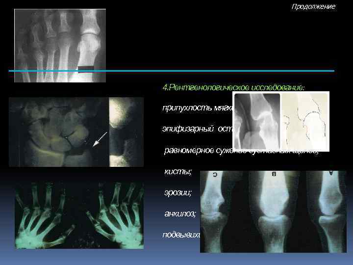 Продолжение 4. Рентгенологическое исследование: припухлость мягких тканей; эпифизарный остеопороз; равномерное сужение суставных щелей; кисты;