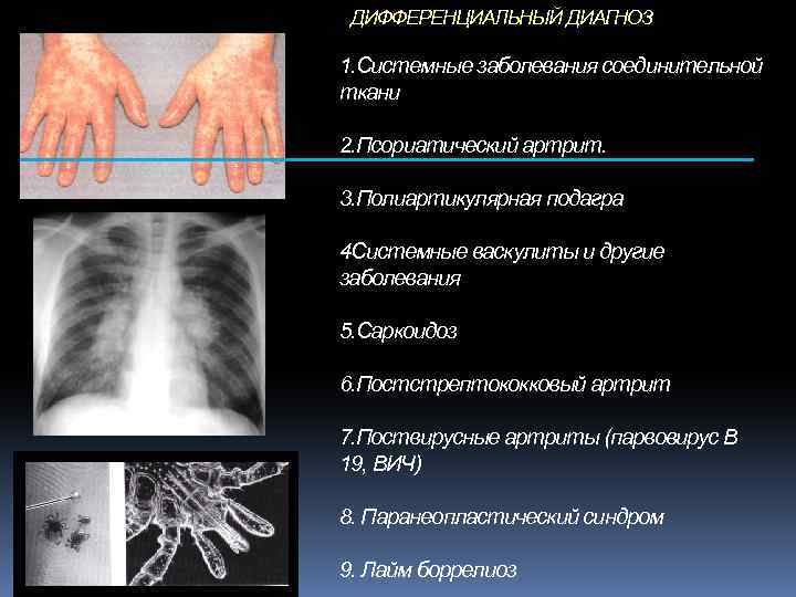 ДИФФЕРЕНЦИАЛЬНЫЙ ДИАГНОЗ 1. Системные заболевания соединительной ткани 2. Псориатический артрит. 3. Полиартикулярная подагра 4