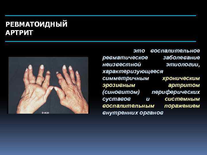 РЕВМАТОИДНЫЙ АРТРИТ это воспалительное ревматическое заболевание неизвестной этиологии, характеризующееся симметричным хроническим эрозивным артритом (синовитом)