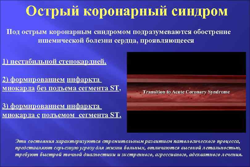 Острый коронарный синдром Под острым коронарным синдромом подразумеваются обострение ишемической болезни сердца, проявляющееся 1)