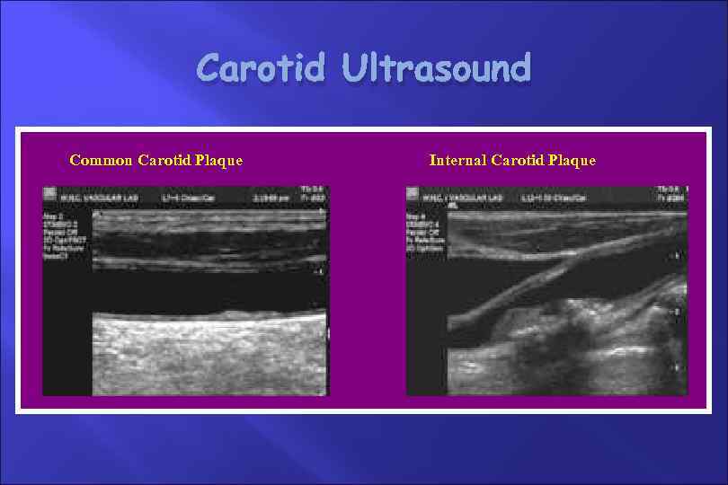 Carotid Ultrasound Common Carotid Plaque Internal Carotid Plaque 