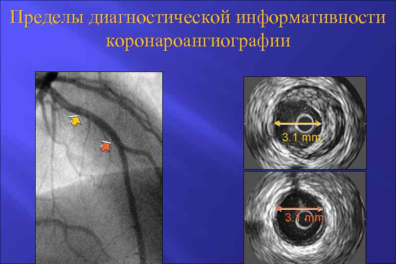 Пределы диагностической информативности коронароангиографии 3. 1 mm 