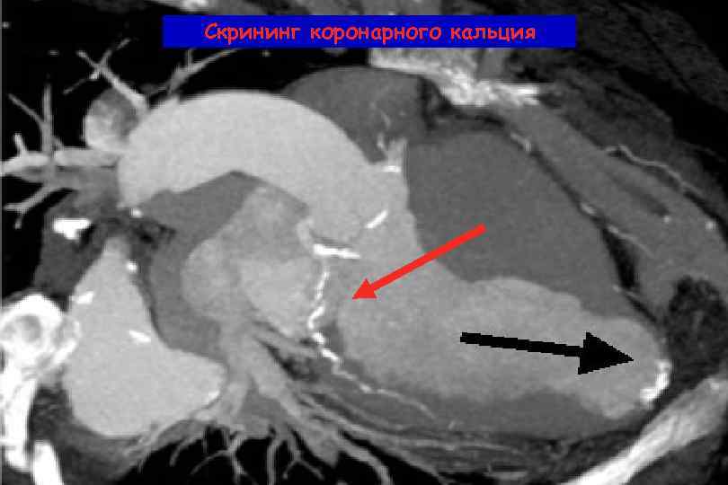 Кт скрининг коронарного кальция