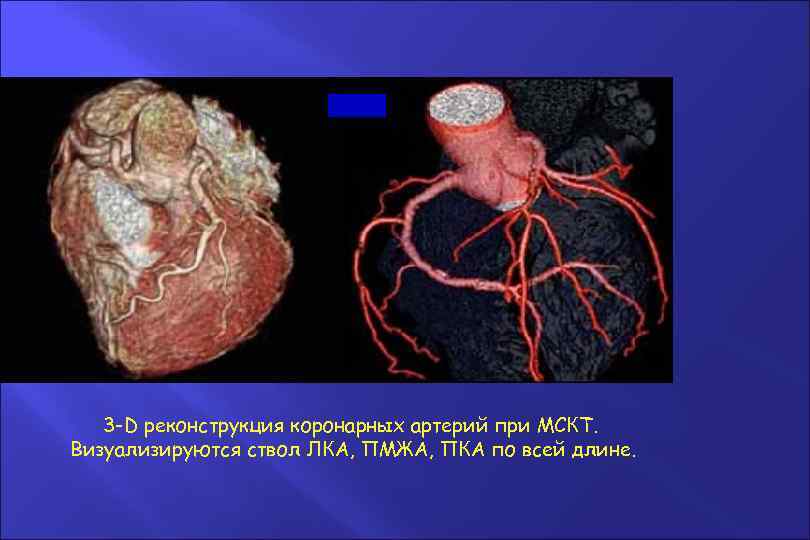 3 -D реконструкция коронарных артерий при МСКТ. Визуализируются ствол ЛКА, ПМЖА, ПКА по всей