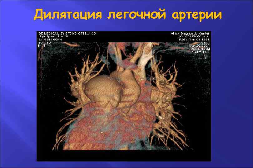 Дилятация легочной артерии 