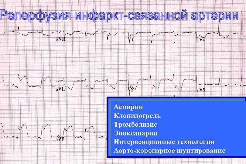Аспирин Клопидогрель Тромболизис Эноксапарин Интервенционные технологии Аорто-коронарное шунтирование 