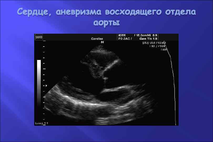 Сердце, аневризма восходящего отдела аорты 