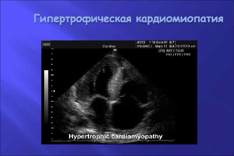 Гипертрофическая кардиомиопатия 