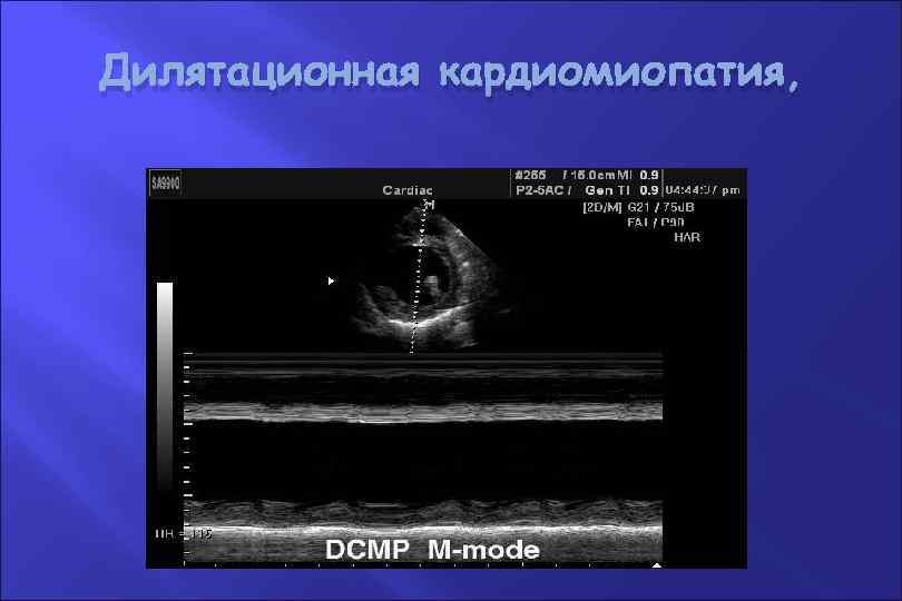 Дилятационная кардиомиопатия, 