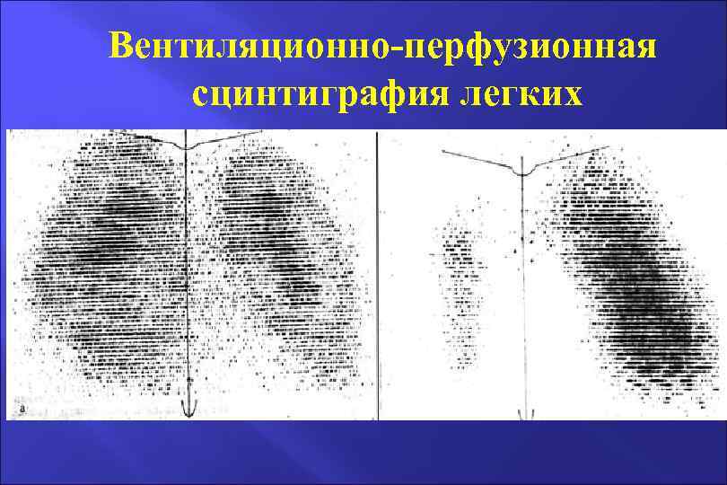 Вентиляционно-перфузионная сцинтиграфия легких 