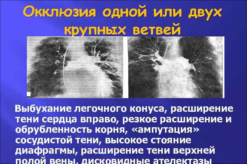 Окклюзия одной или двух крупных ветвей Выбухание легочного конуса, расширение тени сердца вправо, резкое