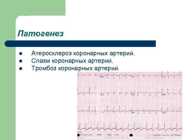 Патогенез l l l Атеросклероз коронарных артерий. Спазм коронарных артерий. Тромбоз коронарных артерий. 