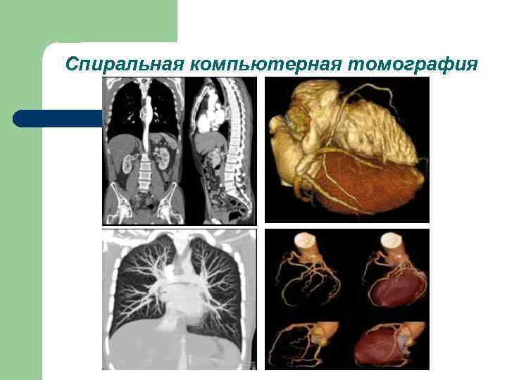 Спиральная компьютерная томография 