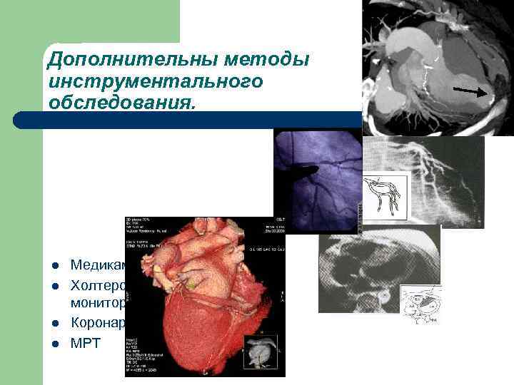 Дополнительны методы инструментального обследования. l l Медикаментозные пробы. Холтеровское мониторирование ЭКГ. Коронарография. МРТ 