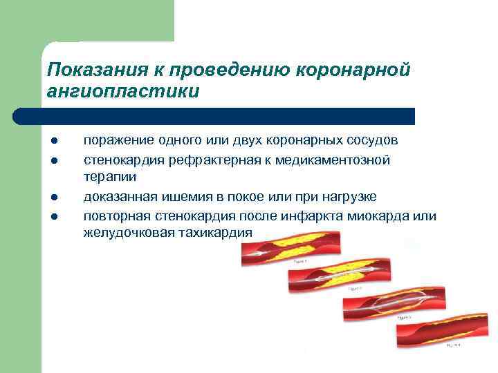 Показания к проведению коронарной ангиопластики l l поражение одного или двух коронарных сосудов стенокардия