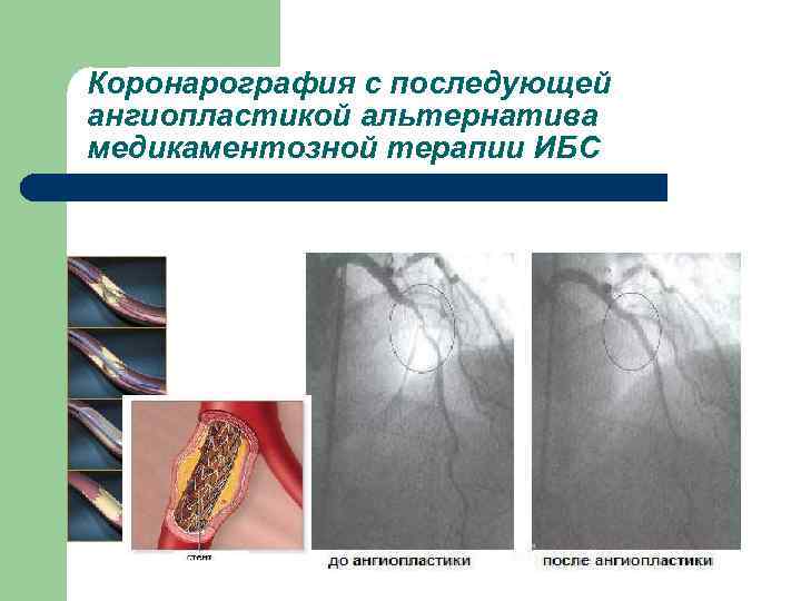 Коронарография с последующей ангиопластикой альтернатива медикаментозной терапии ИБС 