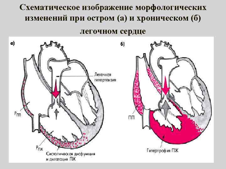Схематическое изображение морфологических изменений при остром (а) и хроническом (б) легочном сердце 