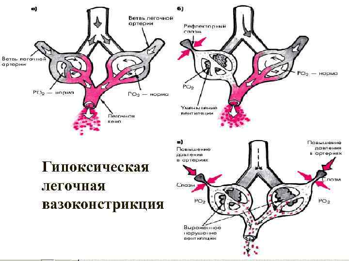 Гипоксическая легочная вазоконстрикция 