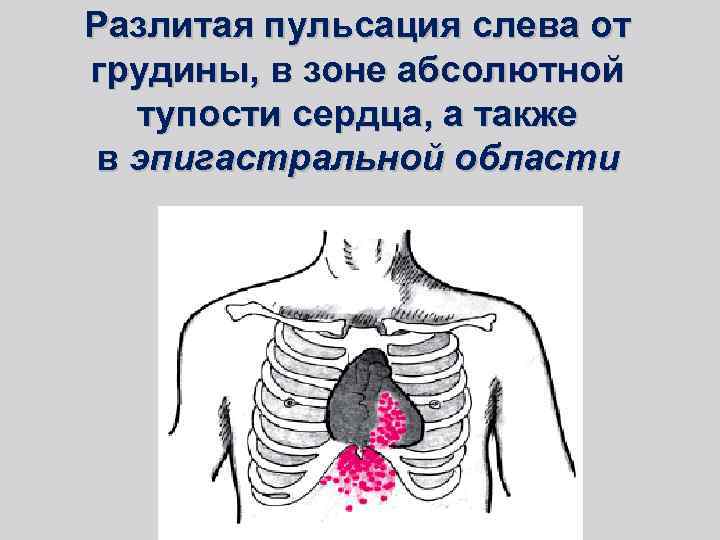 Разлитая пульсация слева от грудины, в зоне абсолютной тупости сердца, а также в эпигастральной