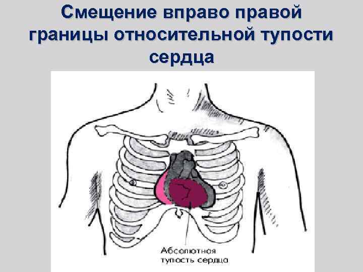 Поперечник относительной тупости сердца