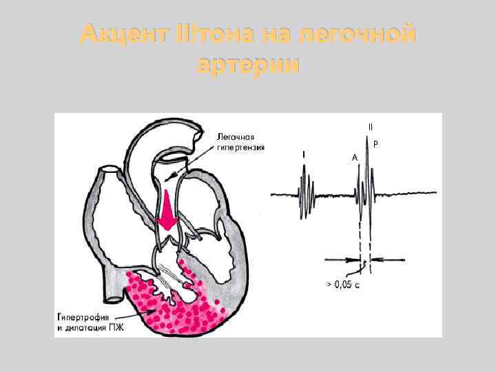 Акцент II тона на легочной артерии 
