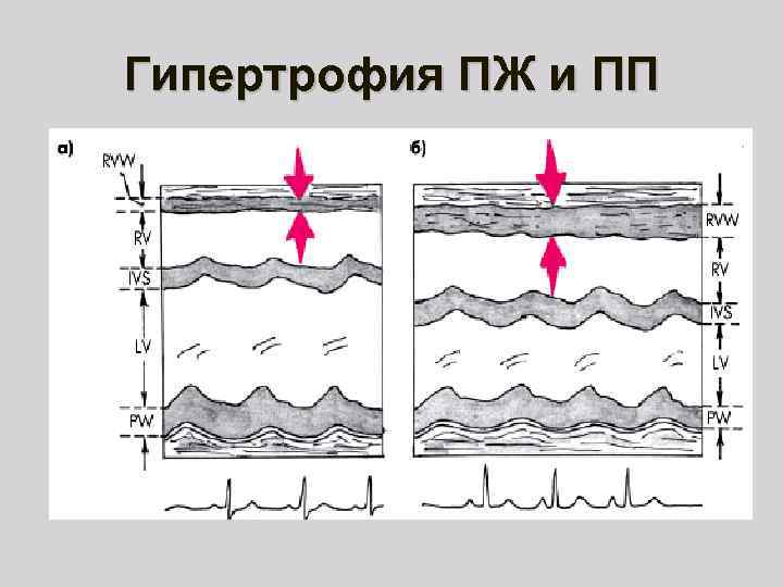Гипертрофия ПЖ и ПП 