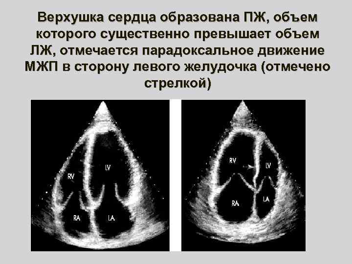 Верхушка сердца образована ПЖ, объем которого существенно превышает объем ЛЖ, отмечается парадоксальное движение МЖП
