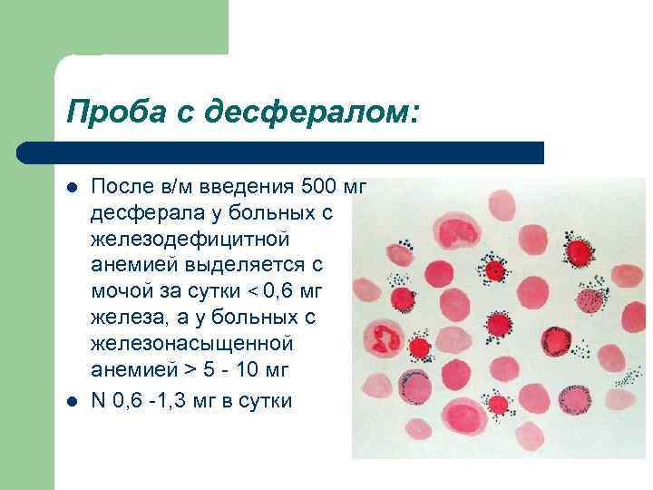 Проба с десфералом: l l После в/м введения 500 мг десферала у больных с