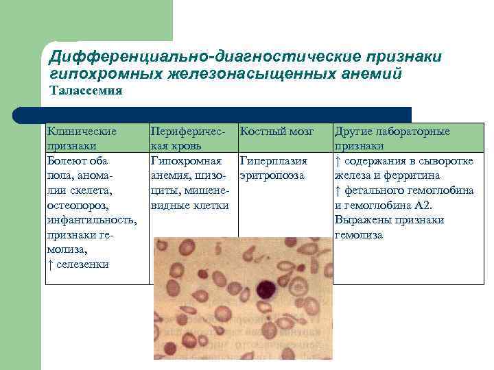 Дифференциально-диагностические признаки гипохромных железонасыщенных анемий Талассемия Клинические признаки Болеют оба пола, анома лии скелета,
