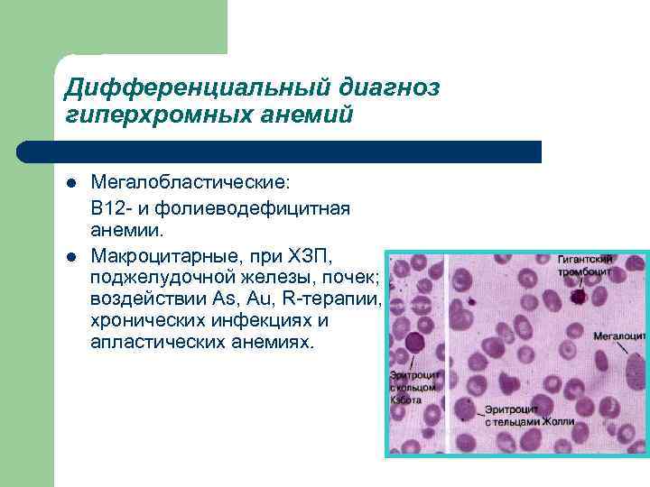 Л 12 диагноз. Макроцитарная анемия (макроцитоз). Гиперхромная нормоцитарная анемия. Гиперхромная мегалобластная макроцитарная анемия. Макроцитарная нормохромная анемия.