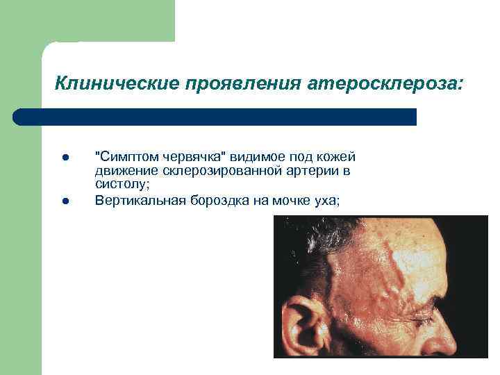 Клинические проявления атеросклероза: l l "Симптом червячка" видимое под кожей движение склерозированной артерии в
