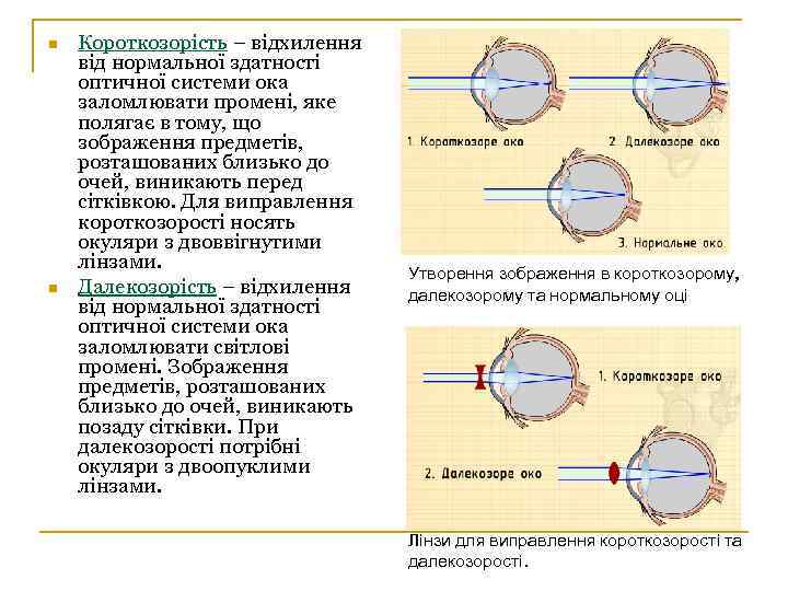 n n Короткозорість – відхилення від нормальної здатності оптичної системи ока заломлювати промені, яке