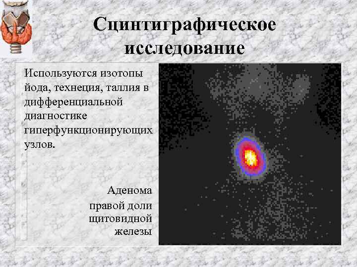 Сцинтиграфическое исследование Используются изотопы йода, технеция, таллия в дифференциальной диагностике гиперфункционирующих узлов. Аденома правой