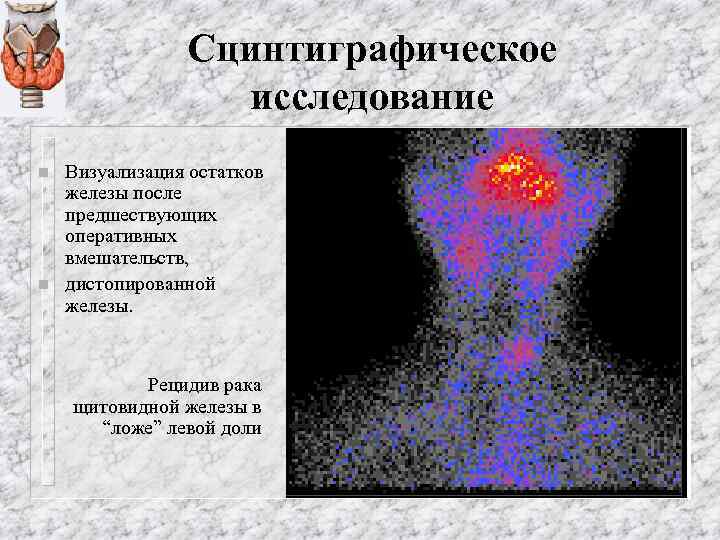 Сцинтиграфическое исследование n n Визуализация остатков железы после предшествующих оперативных вмешательств, дистопированной железы. Рецидив