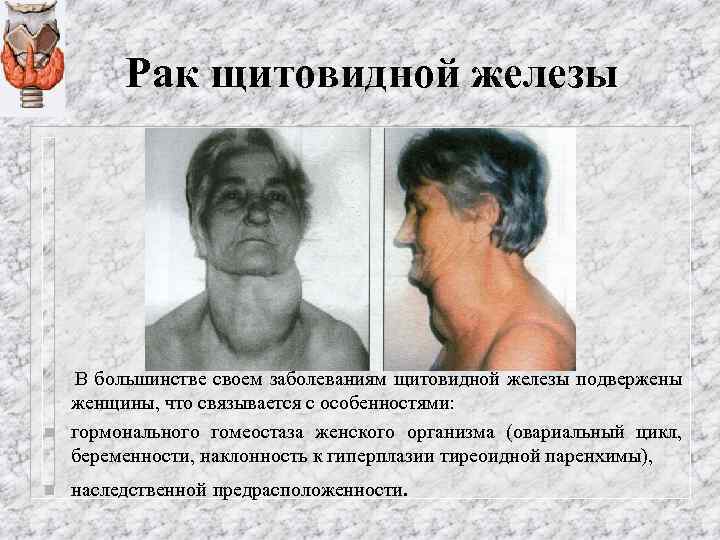 Рак щитовидной железы n n В большинстве своем заболеваниям щитовидной железы подвержены женщины, что
