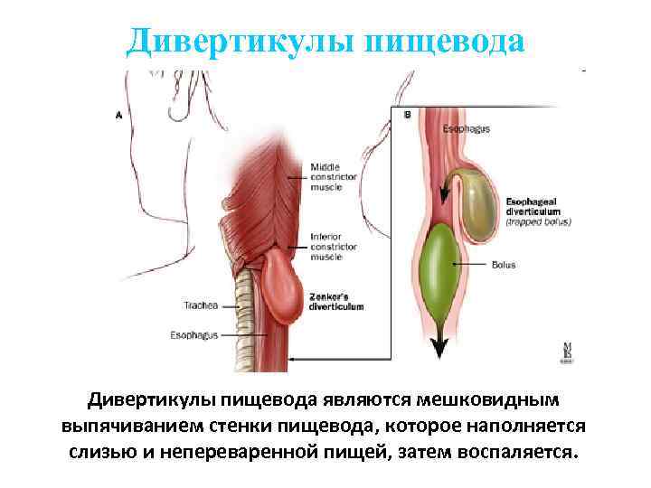 Дивертикулы пищевода являются мешковидным выпячиванием стенки пищевода, которое наполняется слизью и непереваренной пищей, затем