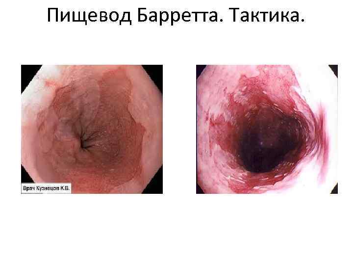 Пищевод Барретта. Тактика. 