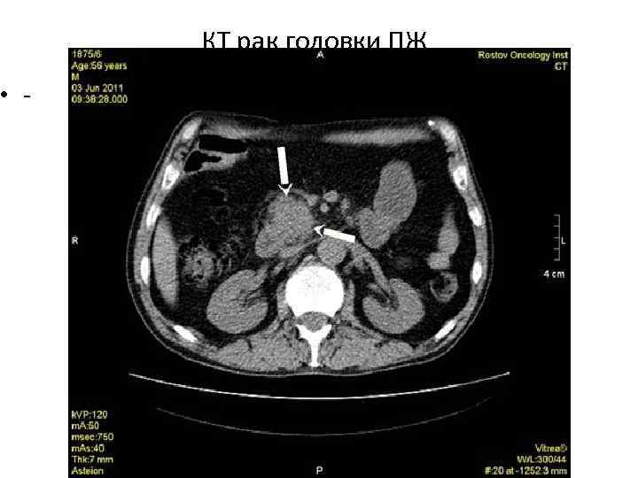  • КТ рак головки ПЖ 