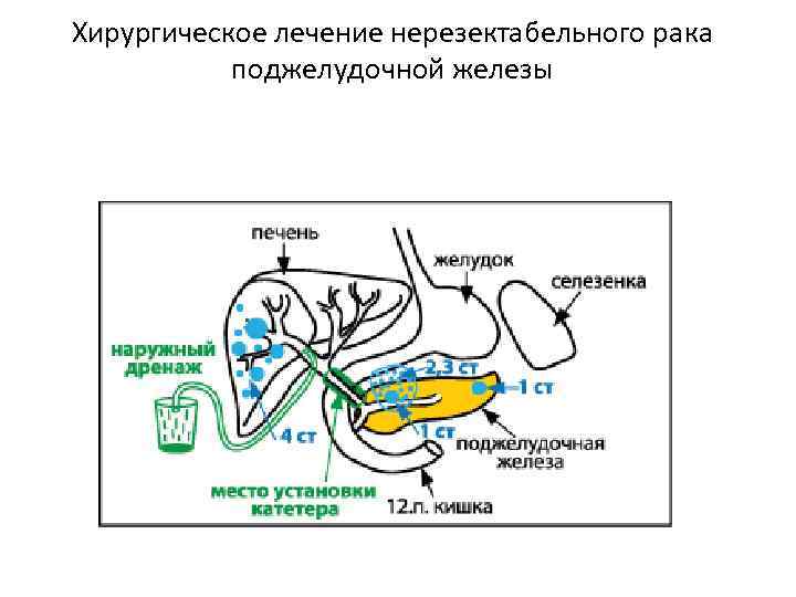 Хирургическое лечение нерезектабельного рака поджелудочной железы 